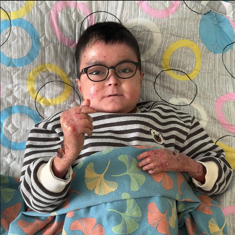 帮助凯威对抗红斑狼疮